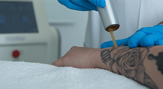 laser-eliminacion-tatuajes