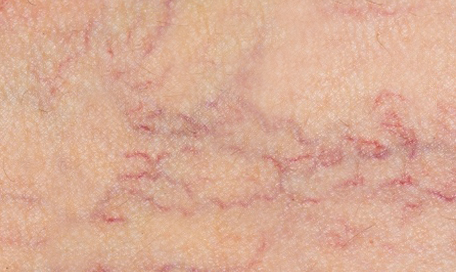 eliminar-varices-piernas-barcelona
