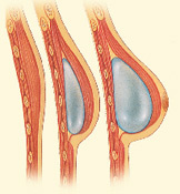 expansor