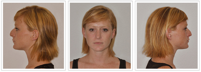 mi-nuevo-yo-3D-facial