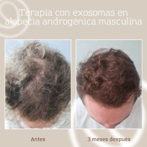 Alt: Resultado tratamiento con exosomas capilares, antes y después en clínica estética de Barcelona y Granollers