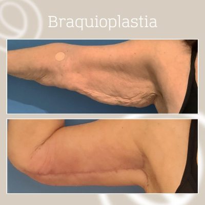 argo-plasma-tratamiento-flacidez-brazos-antes-y-despues Antes y despues Braqu