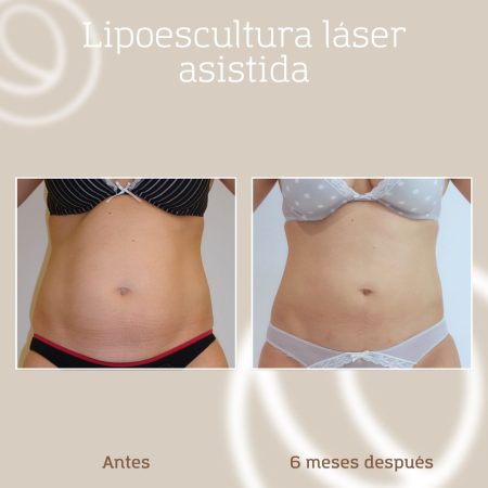 resultado-lipoescultura-tratamiento-grasa-abdominal-mujer-1 Resultado lipoescultura láser asistida, tratamiento en mujer para eliminar grasa abdominal en Barcelona