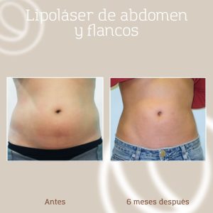resultado-lipolaser-grasa-abdomen-flancos-mujer-1 Eliminación grasa abdomen bajo y flancos en mujer con liposucción láser asistida (resultado de frente)