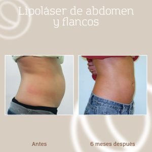 resultado-lipolaser-grasa-abdomen-flancos-mujer-2 Antes y después liposucción láser asistida abdominal y de flancos en mujer (vista de lado)