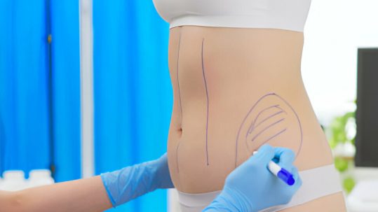 Doctor valora tratamiento para eliminar grasa abdominal en mujer
