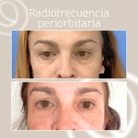 Resultado radiofrecuencia facial periorbitaria tradicional en mujer con mirada cansada