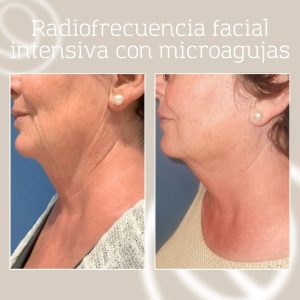 Resultado radiofrecuencia facial fraccionada con microagujas en Barcelona