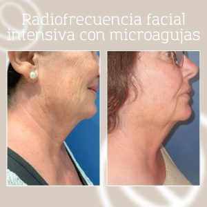 Foto antes y después radiofrecuencia fraccionada con microagujas en rostro mujer