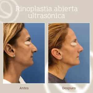 Foto rinoplastia ultrasónica abierta antes y después, paciente vista de lado