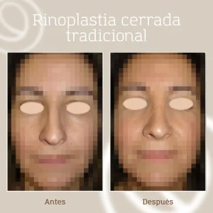 Resultado rinoplastia cerrada tradicional antes y después en Barcelona
