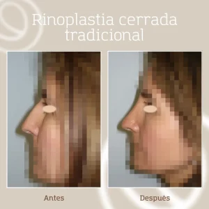 Antes y después rinoplastia cerrada tradicional vista de lado