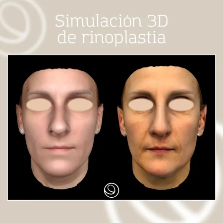 Simulación 3D de una rinoplastia en Cànons Clinics, cirugía plástica y estética en Barcelona y Granollers