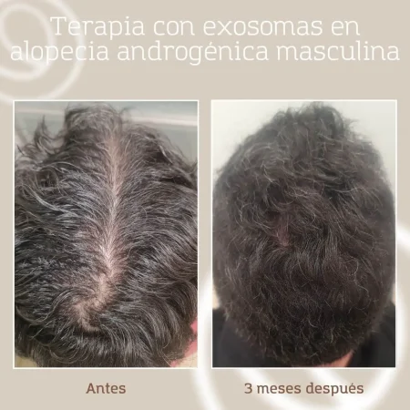 Resultados exosomas capilares en paciente de clínica de Barcelona y Granollers