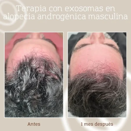Antes y después de un tratamiento capilar con exosomas en Cànons Clinics