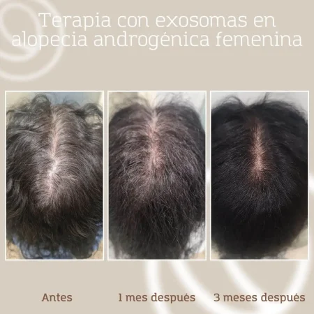 Evolución terapia con exosomas en mujer con alopecia androgénica femenina