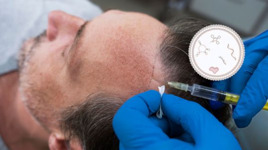 Tratamiento capilar con exosomas en hombre con alopecia