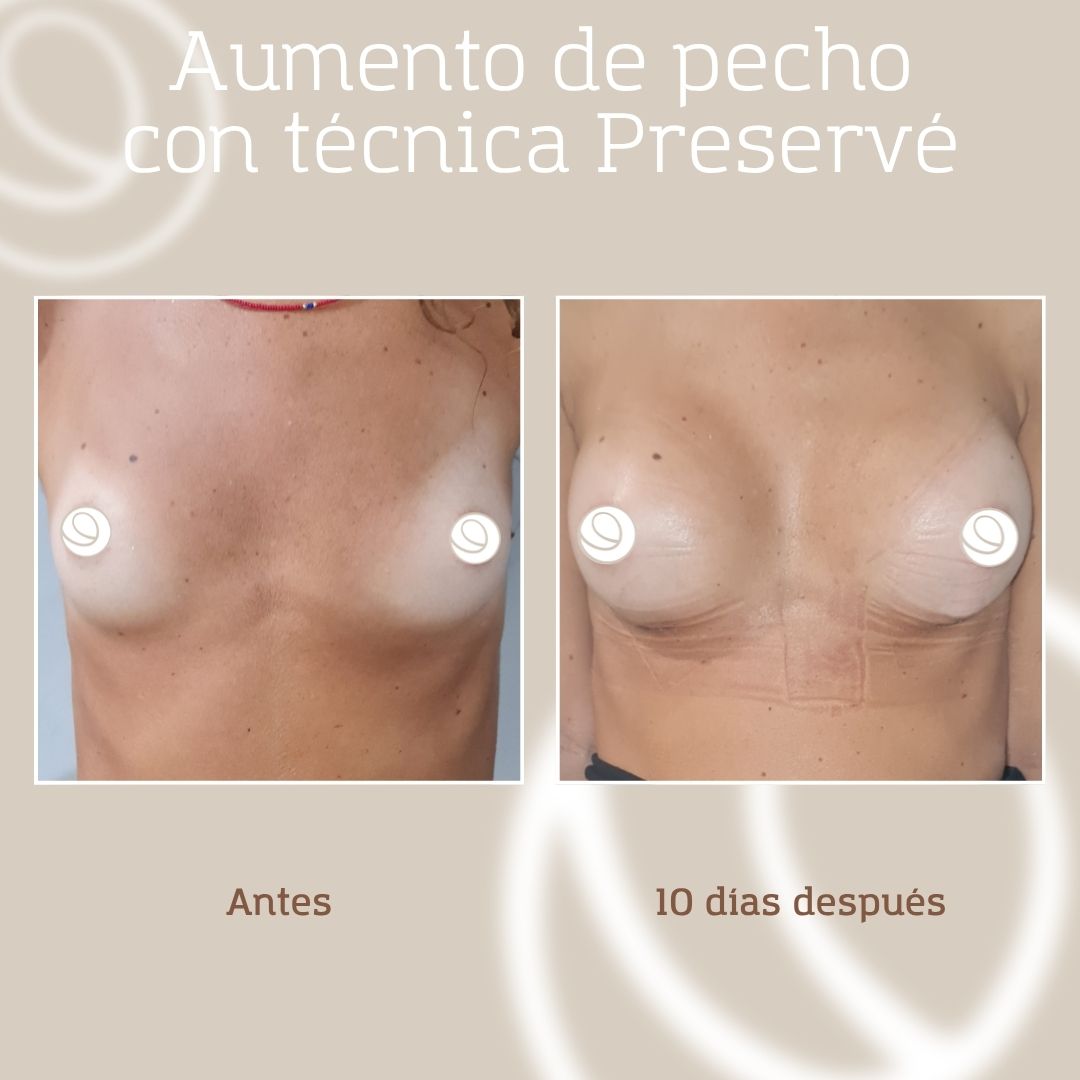 Antes y después nueva técnica de aumento de pecho Preservé, paciente de Cànons Clinics en Barcelona y Granollers