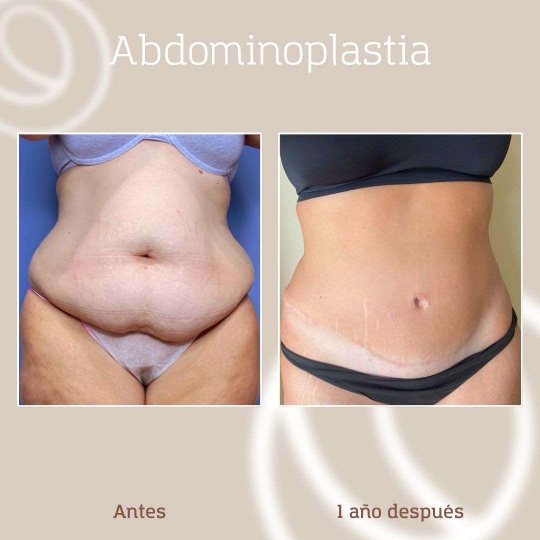 abdominoplastia-antes-despues-1 Resultado abdominoplastia en paciente en la que se aplicó láser UrgoTouch