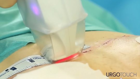 Cirujano usando láser UrgoTouch en cicatriz: opinión, antes y después