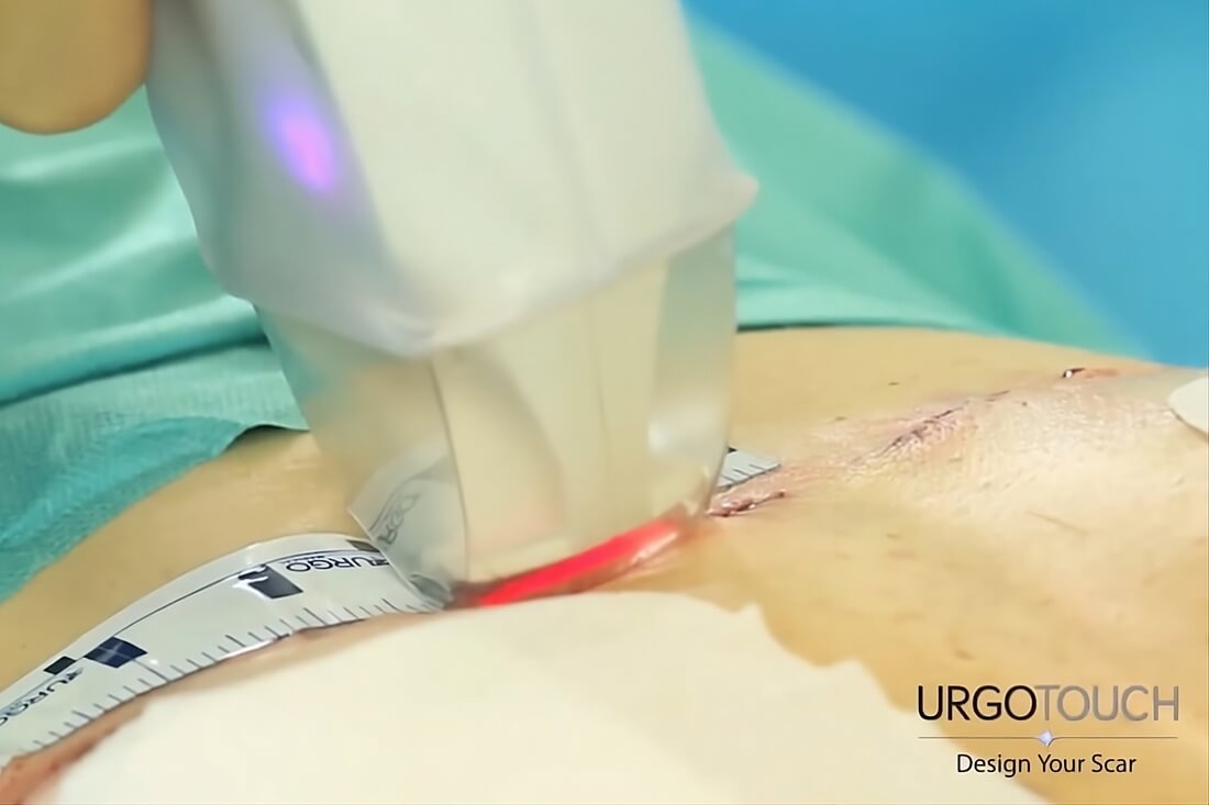 Cirujano usando láser UrgoTouch en cicatriz: opinión, antes y después