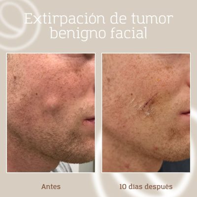 tumor-benigno-facial-antes-despues-1 Antes y después de cirugía de extirpación de tumor benigno facial con aplicación de láser UrgoTouch