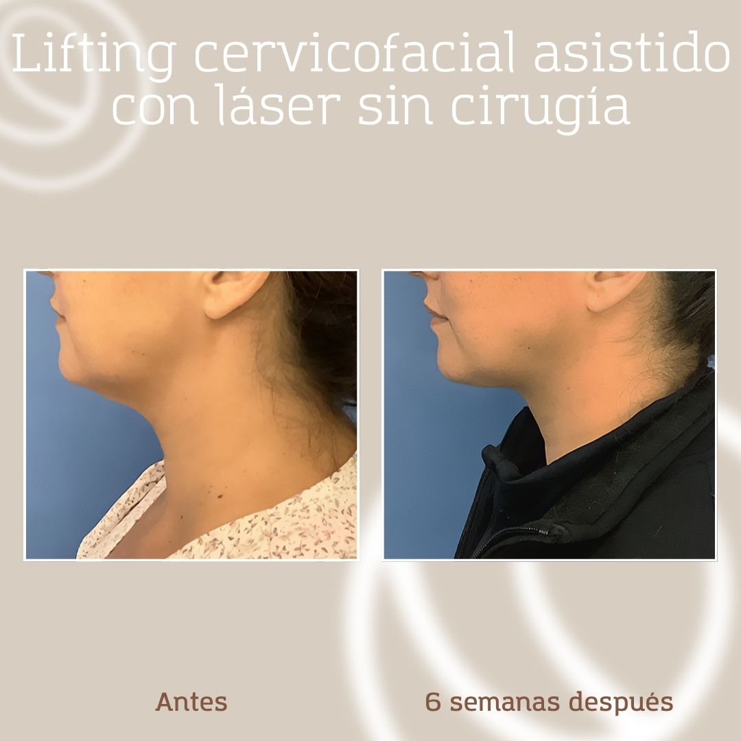 lifting-cervicofacial-laser-sin-cirugia-1.1 Antes y después perfil izquierdo lifting cervicofacial asistido con láser I-Lift + I-Melt, paciente de Cànons Clinics en Barcelona
