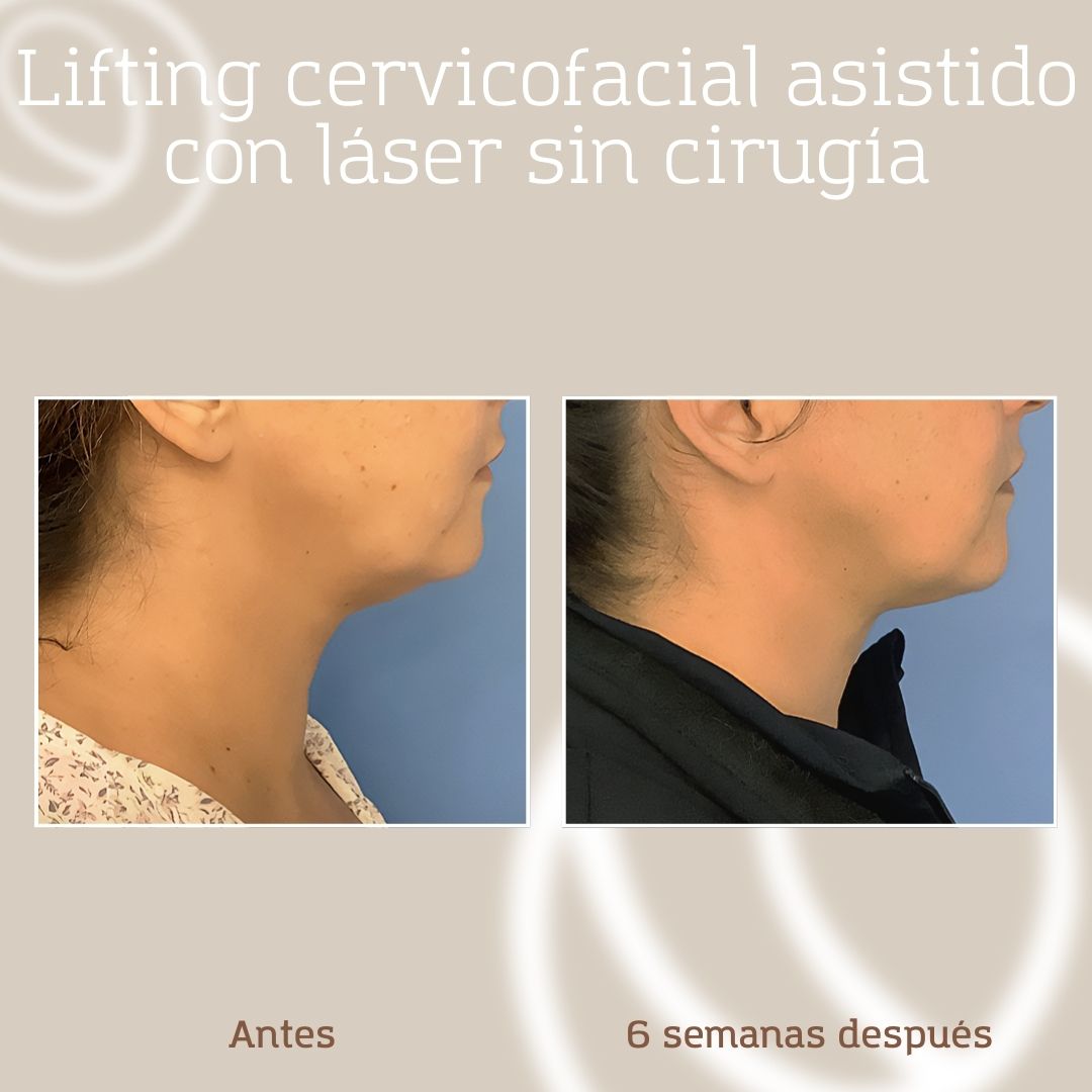 lifting-cervicofacial-laser-sin-cirugia-1.2 Antes y después perfil derecho lifting cervicofacial con láser I-Lift + I-Melt, resultado de Cànons Clinics en Barcelona