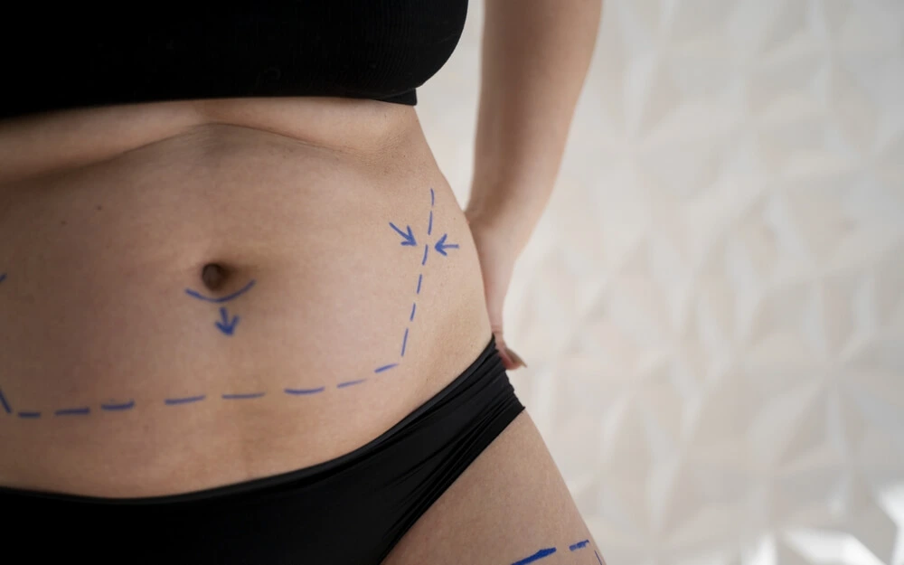 Mujer que se va a realizar un lipoláser con radiofrecuencia