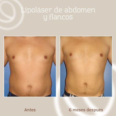 resultado-lipolaser-grasa-abdomen-flancos-hombre-1 Resultado lipoláser en abdomen y flancos de hombre más radiofrecuencia a partir del primer mes de la cirugía