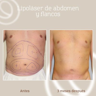 resultado-lipolaser-grasa-abdomen-flancos-hombre-2 Resultado antes y después de una liposucción asistida por láser en abdomen y flancos habiéndose aplicado también radiofrecuencia