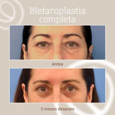 Foto de antes y después de una paciente de blefaroplastia completa que acudió a Cànons Clinics en Barcelona
