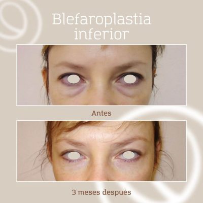 Resultado antes y después de blefaroplastia inferior en paciente joven mujer que sufría bolsas muy prematuras