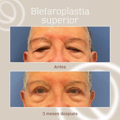 Resultado definitivo de blefaroplastia superior en paciente de Cànons Clinics, clínica de cirugía plástica en Barcelona