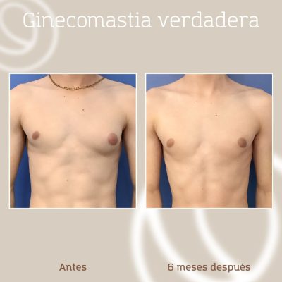 resultado-cirugia-ginecomastia-hombre-1 resultado-cirugia-ginecomastia-hombre-1