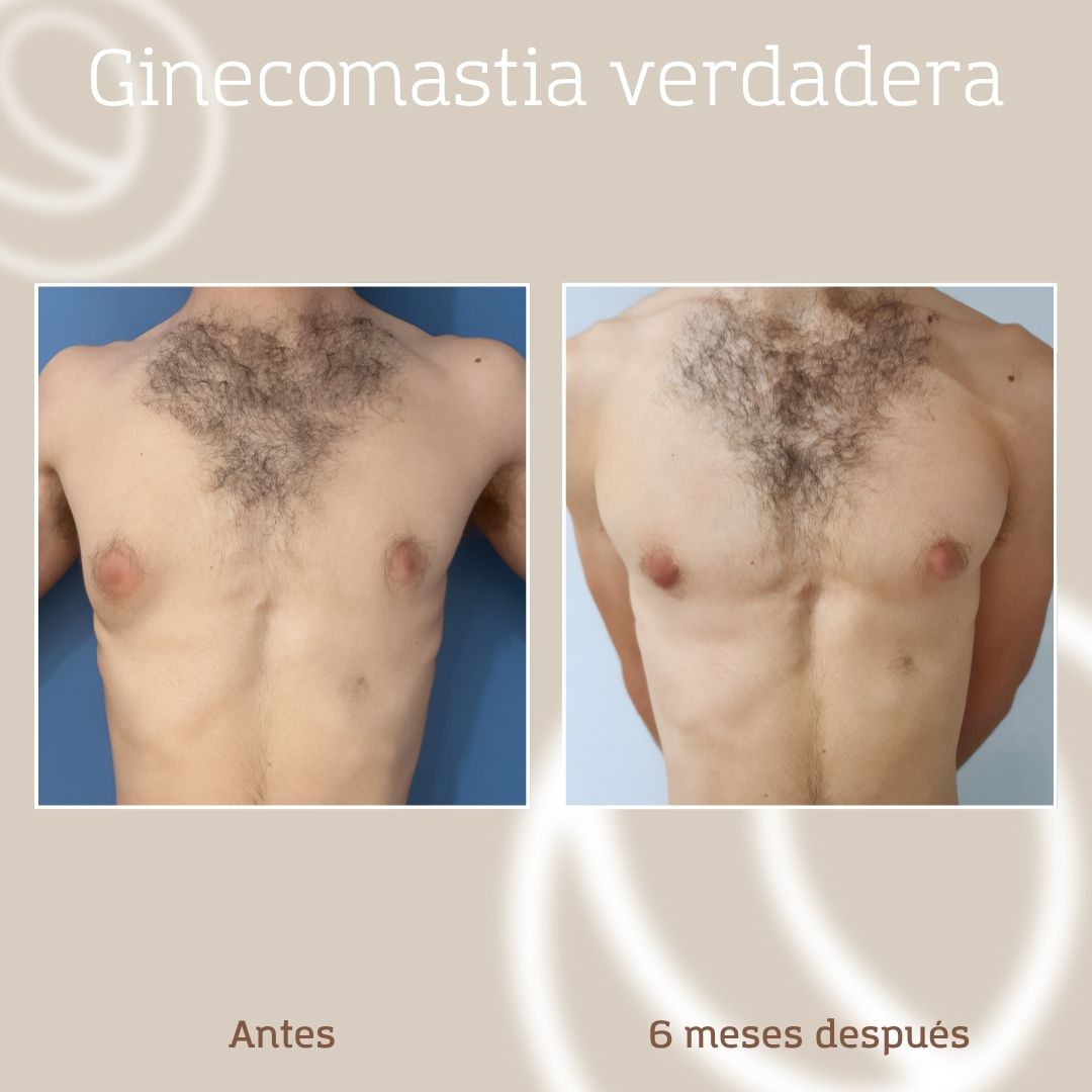 resultado-cirugia-ginecomastia-hombre-2