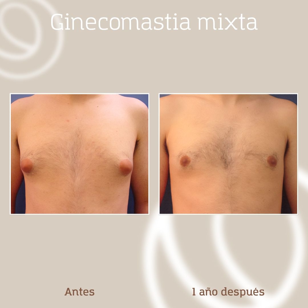resultado-cirugia-ginecomastia-hombre-3 Resultado antes y después de una liposucción asistida por láser en paciente varón que presentaba ginecomastia mixta