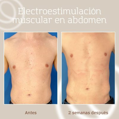 Resultado y beneficios estéticos visibles de un tratamiento de electroestimulación muscular con truFlex de Cutera en abdomen
