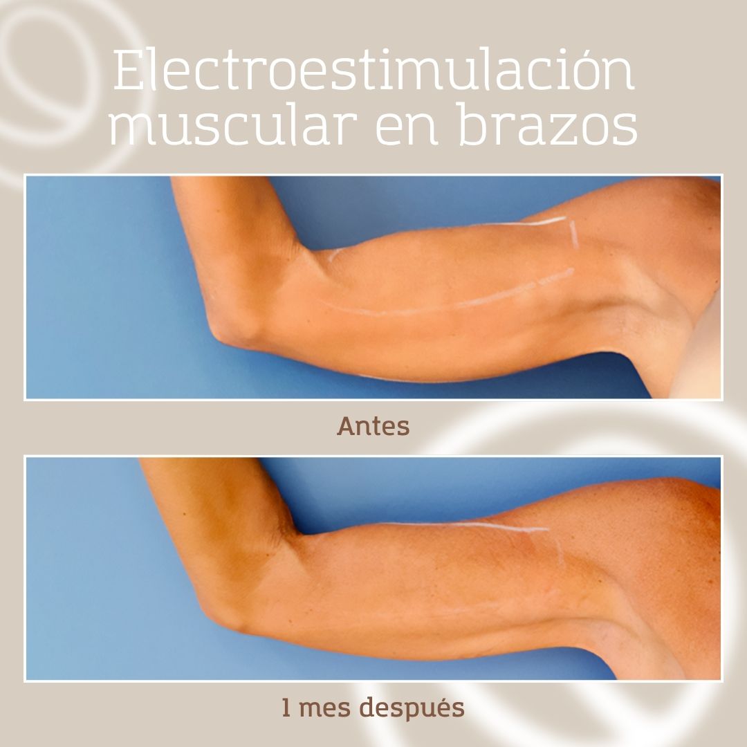 Resultado de electroestimulación muscular en brazos de mujer que tiene lo que se conoce como "alas de murciélago"
