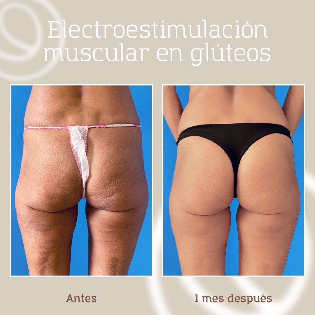 Antes y después de un tratamiento de electroestimulación muscular (EMS) para corregir la flacidez de glúteos en clínica de cirugía plástica y medicina estética en Barcelona
