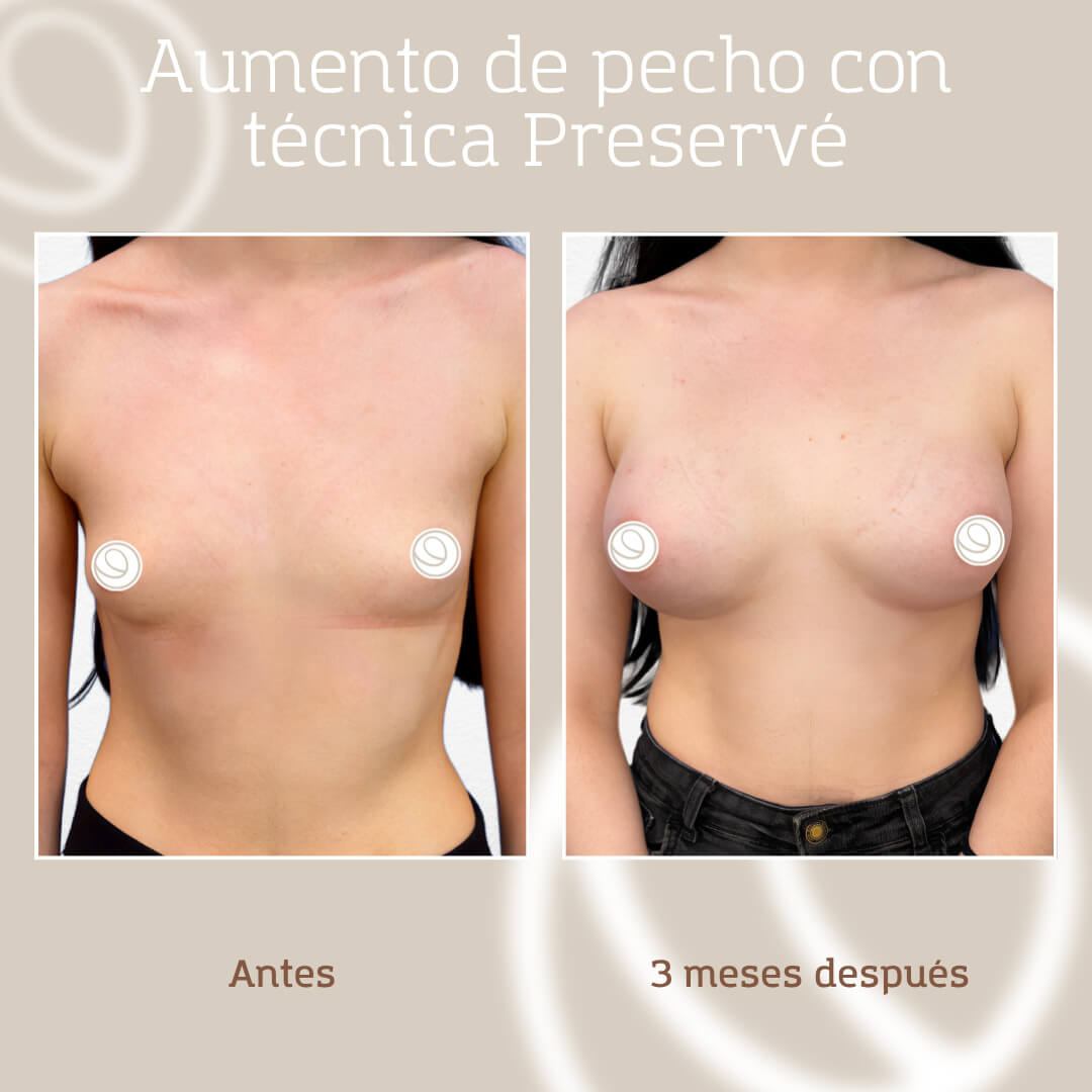 Antes y después de una paciente de aumento de pecho con técnica Preservé en clínica de cirugía plástica en Barcelona y Granollers