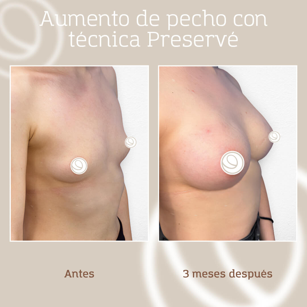 Resultado visto de perfil de una paciente de aumento mamario con técnica Preservé