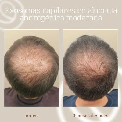 resultado-tratamiento-capilar-exosomas-aga-hombre-4 Resultado a los 3 meses de un tratamiento capilar de exosomas en paciente de Cànons Clinics con AGA tipo III vértex