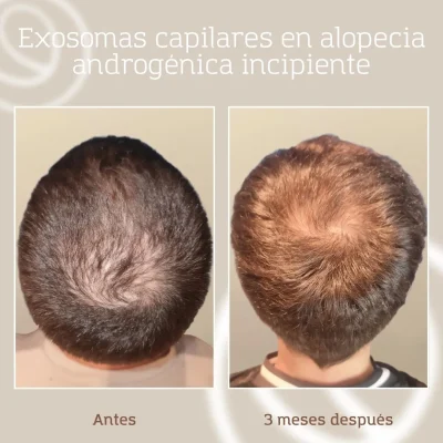 resultado-tratamiento-capilar-exosomas-aga-hombre-5 Antes y después de paciente joven que sufría alopecia incipiente y se le trató con exosomas capilares en Cànons Clinics