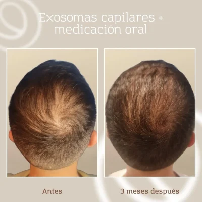 resultado-tratamiento-capilar-exosomas-aga-hombre-6 Resultado de exosomas capilares en un paciente con alopecia, tratamiento realizado en una clínica estética de Barcelona y Granollers