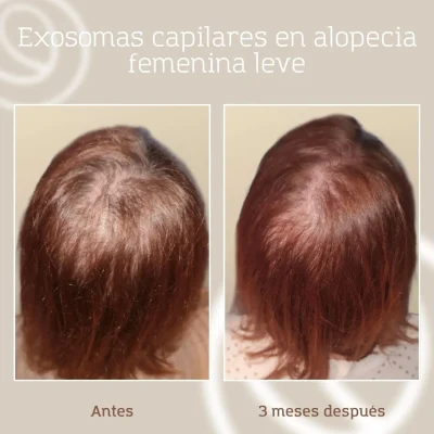 resultado-tratamiento-capilar-exosomas-faga-mujer-2 Antes y después de paciente mujer con alopecia leve de patrón femenino a la que se le aplicó un tratamiento capilar de exosomas en Barcelona