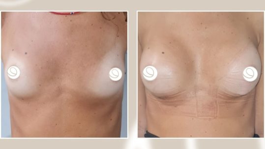 Portada casos antes y después de aumento de pecho técnica Preservé