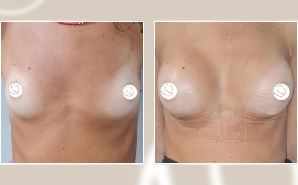 Portada casos antes y después de aumento de pecho técnica Preservé